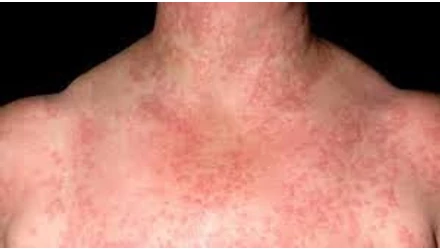 Rejtélyes bőrkiütések Budán